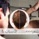 تساقط الشعر الأسباب والعلاج